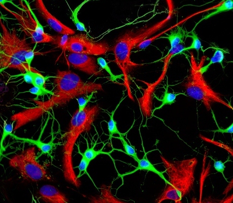 Blog: Astrocytes Ignite New Therapies for ALS | ALS Therapy Development ...