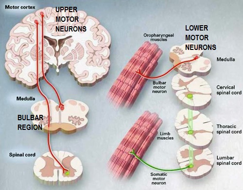 clinical-manifestation-of-motor-neurone-disease-webmotor